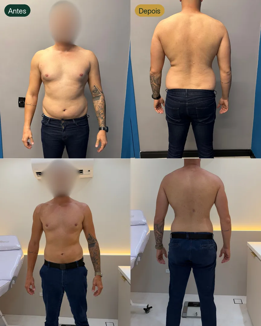 Antes e depois de paciente