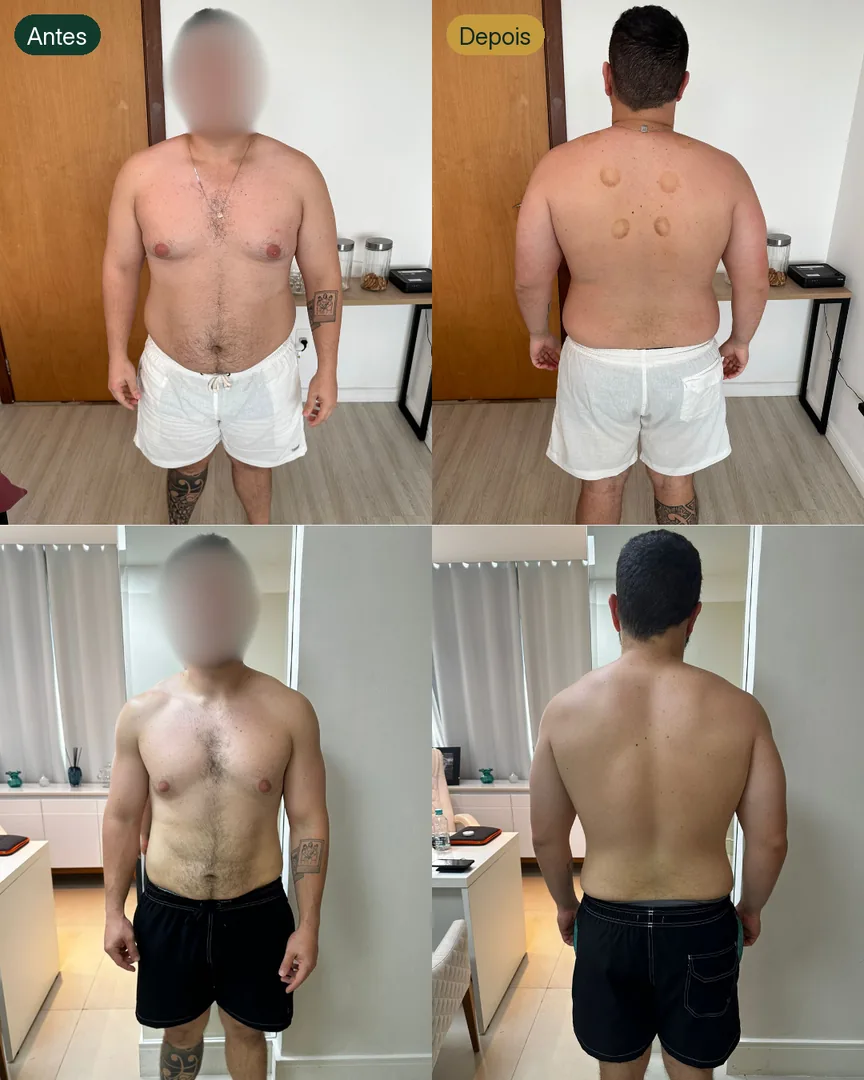 Antes e depois de paciente