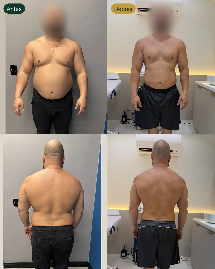 Antes e depois de paciente